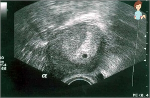 Ultraschall, Schwangerschaft 2-3 Wochen