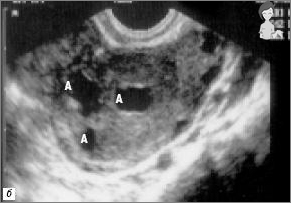 Foto-Ultraschall - 1 Woche Schwangerschaftswoche