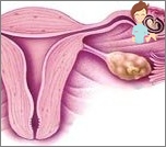 الحمل خارج الرحم - لماذا وماذا?